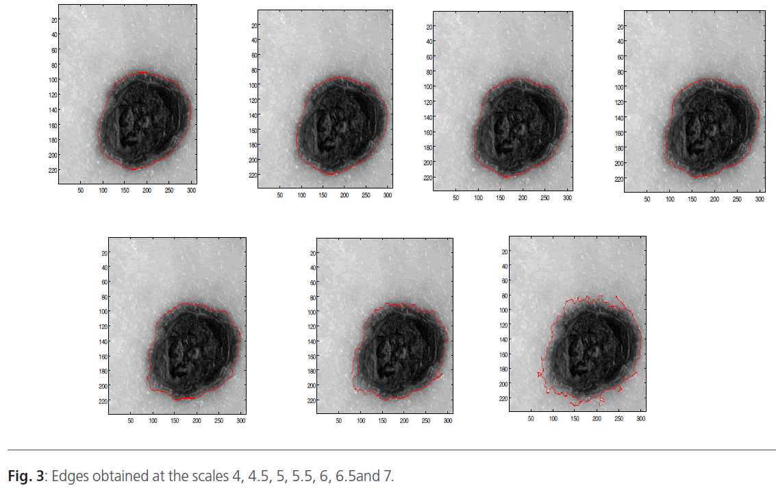 Segmentation And Characterization Of Skin Tumors Images Used For Aided Diagnosis Of Melanoma Insight Medical Publishing